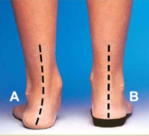 back view of feet. Left ankle is curved. right ankle corrected with orthotic.