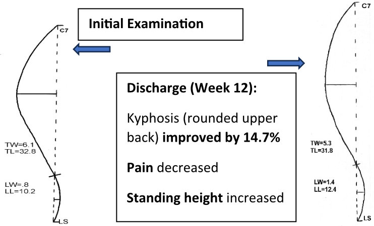 chart of curved spine treatment and results. Pain decreased, standing height increased.
