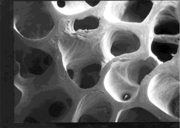 Normal bone density.